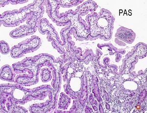 cured Whipple disease (HE) cured Whipple disease (HE)
